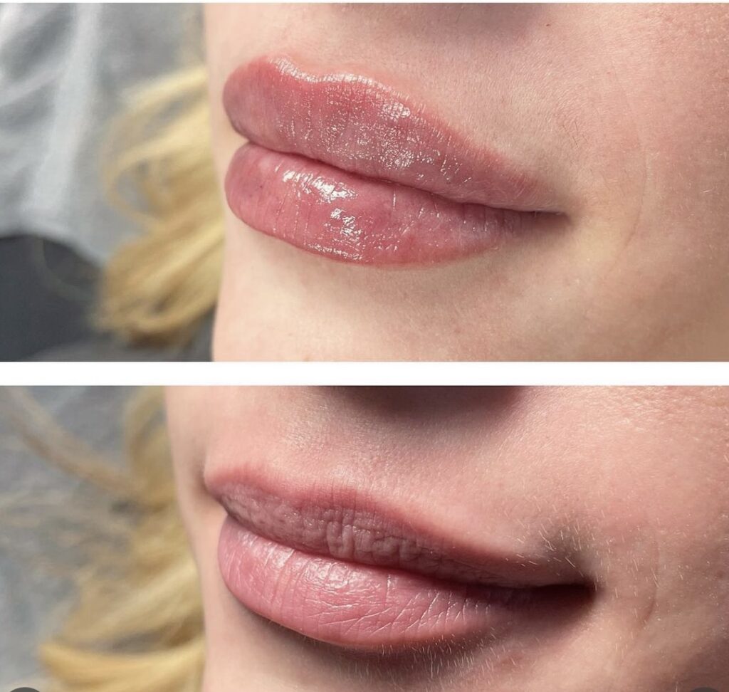 lip flip